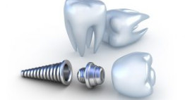 Ghép răng implant bao nhiêu tiền? Giá chuẩn liên tục cập nhật