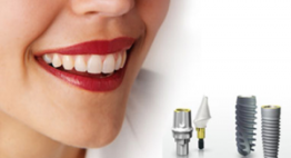 Giá trồng răng Implant là bao nhiêu? – Công thức tính giá chuẩn nhất