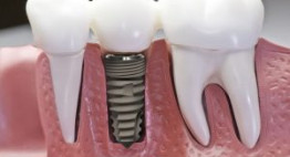Trồng răng Implant giá bao nhiêu là hợp lý [BẢNG GIÁ CHUẨN 2017]