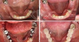 Bạn đã biết quy trình làm răng implant được thực hiện như thế nào chưa?