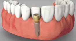 Trồng răng implant ở đâu tốt cho kết quả đẹp ưng ý
