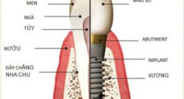 Bác sĩ giải đáp: Trồng răng implant mất bao lâu?