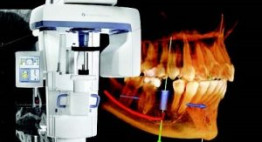 Cấy ghép răng bằng phương pháp Implant OP300 hiện đại