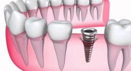 Chuyên gia giải đáp thắc mắc: Trồng răng implant có nguy hiểm không?