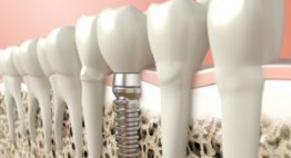 Địa chỉ cung cấp dịch vụ trồng răng implant uy tín và chất lượng
