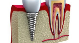 Giá răng sứ implant bao nhiêu? – Cập nhật liên tục