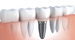 Chia sẻ kinh nghiệm: Ghép răng implant ở đâu an toàn