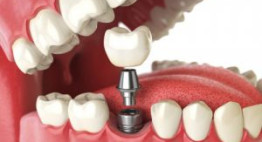 Nha khoa nào có chi phí làm răng implant phù hợp?