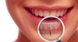 Những lợi ích từ phương pháp ghép răng Implant là gì?