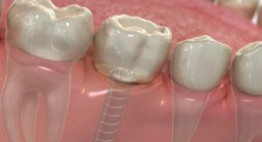 Thông tin chi tiết về giá răng implant hiện tại bạn nên biết
