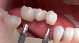 Trồng răng implant có nguy hiểm không? << Xem Ngay