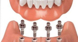 Trồng răng implant mất bao lâu? – Thời gian chuẩn nhất cho bạn