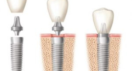 8 lý do để lựa chọn công nghệ trồng răng implant phục hình răng mất