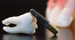 Công nghệ cắm ghép răng implant OP300 – Giải pháp phục hình răng hoàn hảo
