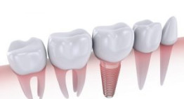 “Khai quật” triệt để 10 ưu điểm của cấy ghép răng implant