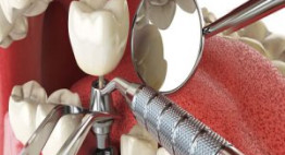 Những điều mà ai cũng nên biết về phương pháp trồng răng implant