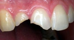 Răng bị gãy còn chân răng có phục hình được nguyên vẹn không?