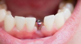Trồng răng bằng phương pháp implant có đau không? – Góc nhìn chuyên gia