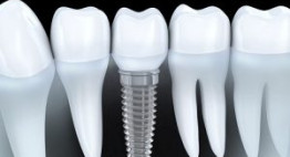 Trồng răng công nghệ implant OP300 – Tái tạo răng mất hoàn hảo nhất