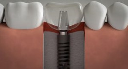 Trồng răng hàm implant – Phục hình răng hàm, cải thiện ăn nhai tốt nhất
