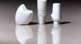 Trồng răng implant có bền không? – Ý kiến khách hàng đã thực hiện dịch vụ
