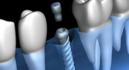 Cắm implant sau nhổ răng có được không?
