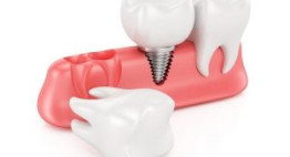 Cắm răng implant vào thời điểm nào là tốt nhất?