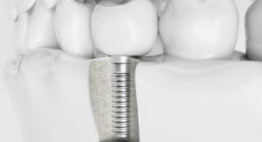 Cấy ghép răng implant có bền không – chia sẻ từ chuyên gia nha khoa