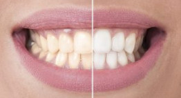 Cách trị răng ố vàng hiệu quả giúp bạn tự tin với nụ cười trắng sáng