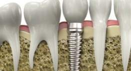 Đối tượng nào có thể cấy ghép răng implant? XEM NGAY