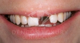 Cấy ghép implant răng cửa được thực hiện như thế nào?