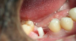 Trồng răng hàm số 6- phục hình răng hàm không thể bỏ qua.