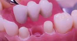 Chuyên gia lý giải: Có nên trồng răng sứ khi bị mất răng hay không?