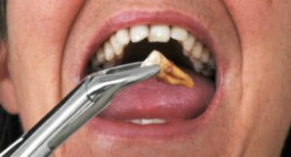 Phương pháp nhổ răng an toàn bằng máy siêu âm không gây biến chứng