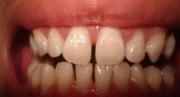 Răng thưa và cách khắc phục răng thưa hiệu quả, đẹp tự nhiên