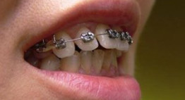 Răng vẩu phải làm sao? – 3 bước đơn giản để có răng đều đẹp tự nhiên