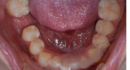 Tại sao nên trồng răng Impplant khi mất răng hàm?