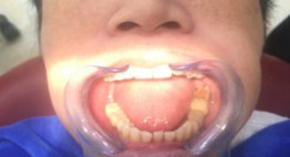 Cắm ghép răng implant – Giải pháp tuyệt vời cho hàm răng khiếm khuyết