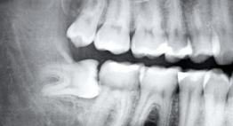 Đi tìm lời giải cho thắc mắc: Nhổ răng số 8 mọc lệch có nguy hiểm không?