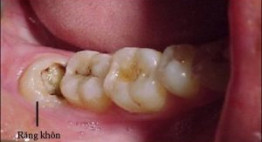Nhổ răng khôn đau mấy ngày và những điều cần chú ý sau khi nhổ răng?