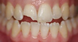 2 cách khắc phục răng bị mẻ hiệu quả và bền chắc không thể bỏ qua