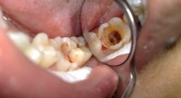 Răng sâu bị lung lay nên nhổ bỏ hay giữ lại? [Chuyên gia giải đáp]