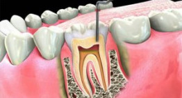 Giải pháp khắc phục với trường hợp răng cấm bị lung lay