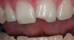 Răng bị mẻ phải làm sao? – Phương pháp nào điều trị tốt nhất hiện nay?