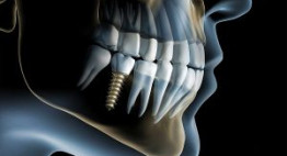 Trồng răng implant có bị đào thải không?