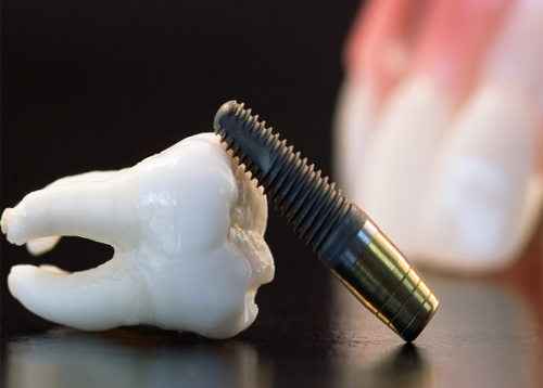 có-nên-trồng-răng-implant