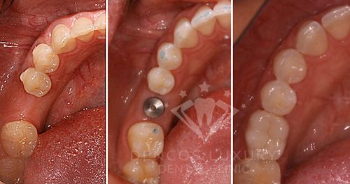 kết quả khách hàng trồng răng implant tại địa chỉ nha khoa uy tín