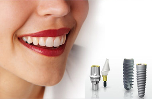 giá trồng răng implant