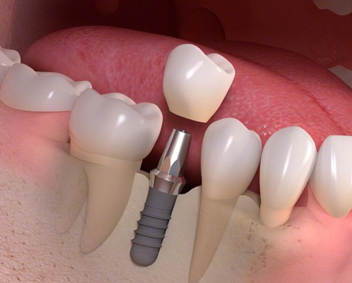 trồng răng Implant có đau không