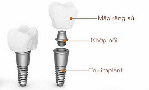 răng implant là gì